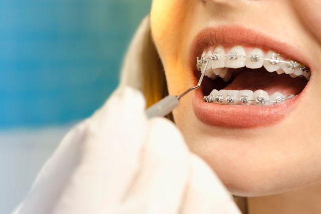 Braces: Should You Get Them?